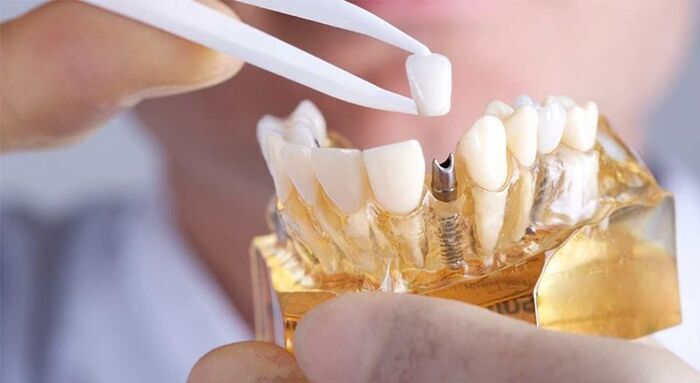 Индивидуальный практический курс `Особенности протезирования на имплантах`, 30 октября 2020, Запорожье Zooble.com.ua