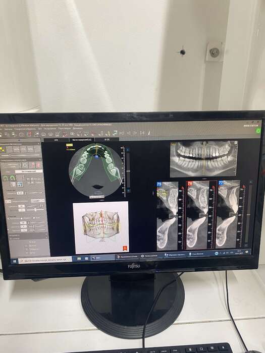 Комп ютерний томограф NewTom Giano Виробник - Італія Рамка 11*8 В комплекті з ПЗ та комп ютером Стан - відмінний Zooble.com.ua