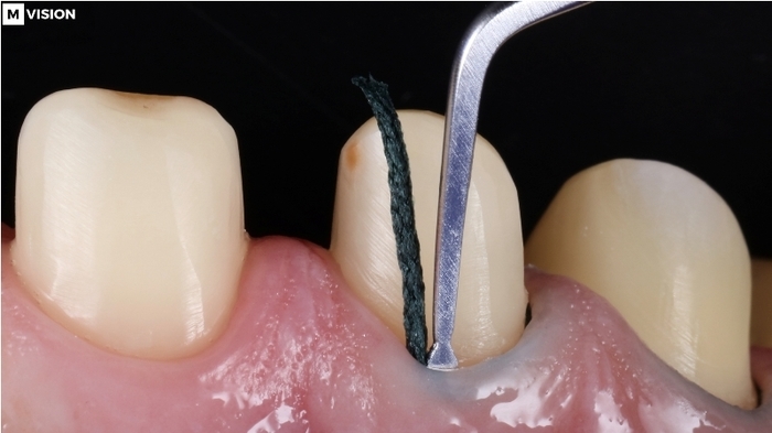 Пакери для встановлення ретракційної нитки Zooble.com.ua