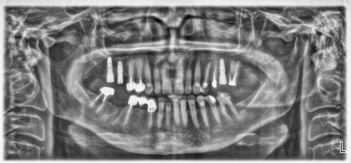 Панорамний рентген Planmeca ProONE 2017 рік. 773 знімка. Zooble.com.ua