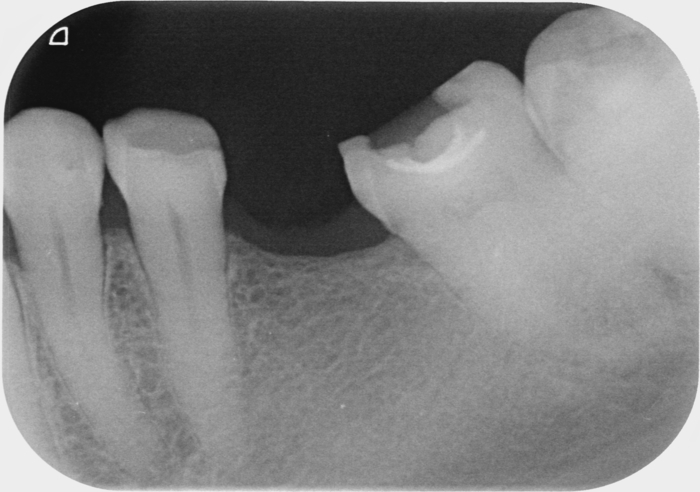 Продам рентген SIMENS SIRONA HELIODENT 70 БУ. Рабочий, образцы снимков приложены. Zooble.com.ua