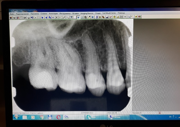 Рентген Anthos Partner 70 + сканер пластин Gendex + комп з ПЗ і монітором + 3 фосфорних датчики і комплект чохлів Zooble.com.ua