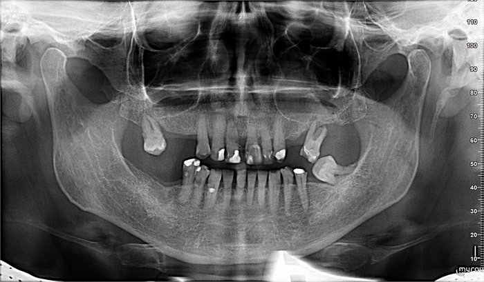 Стоматологічний рентген апарат My Ray Hyperion MRT Zooble.com.ua