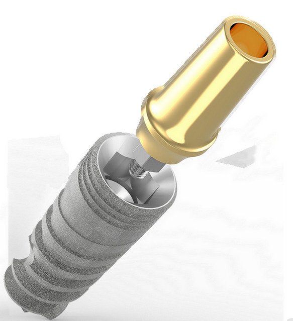 Зубні імплантати TOV IMPLANT (Ізраїль) Найвища якість за помірну ціну! Zooble.com.ua